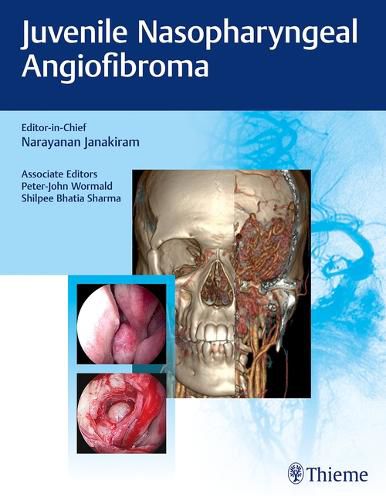 Cover image for Juvenile Nasopharyngeal Angiofibroma
