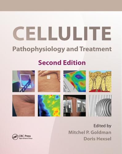 Cellulite: Pathophysiology and Treatment