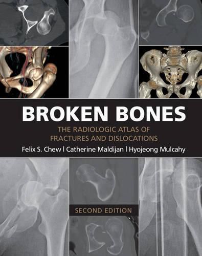 Cover image for Broken Bones: The Radiologic Atlas of Fractures and Dislocations