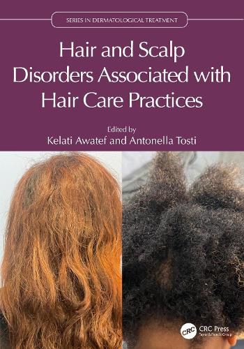 Cover image for Hair and Scalp Disorders Associated with Hair Care Practices