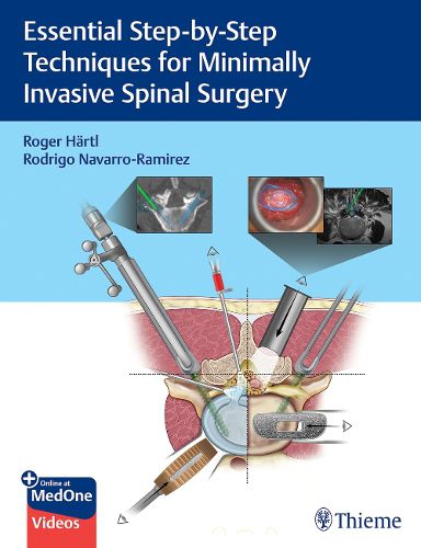 Cover image for Essential Step-by-Step Techniques for Minimally Invasive Spinal Surgery