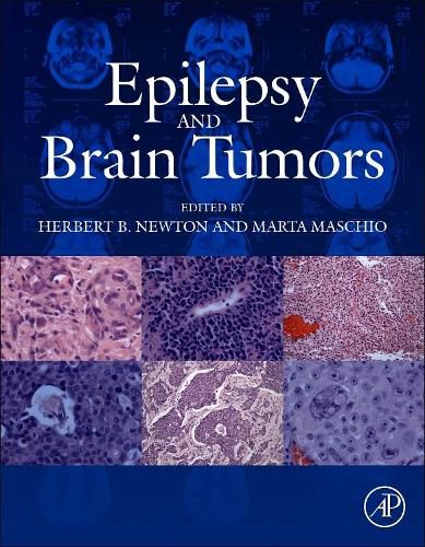 Cover image for Epilepsy and Brain Tumors