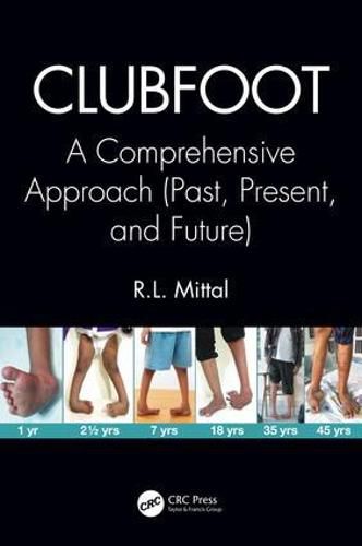 Cover image for Clubfoot: A Comprehensive Approach (Past, Present, and Future)