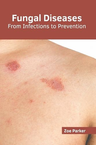 Cover image for Fungal Diseases: From Infections to Prevention