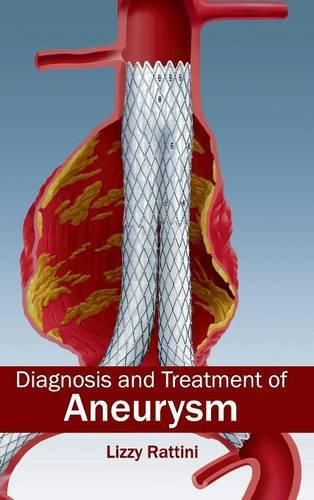 Cover image for Diagnosis and Treatment of Aneurysm