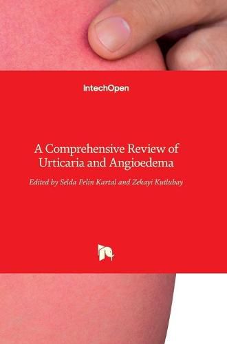 Cover image for Urticaria and Angioedema: A Comprehensive Review of