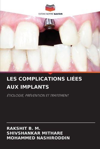 Cover image for Les Complications Liees Aux Implants