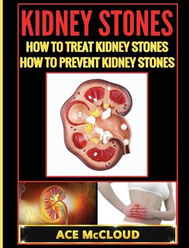 Cover image for Kidney Stones: How To Treat Kidney Stones: How To Prevent Kidney Stones