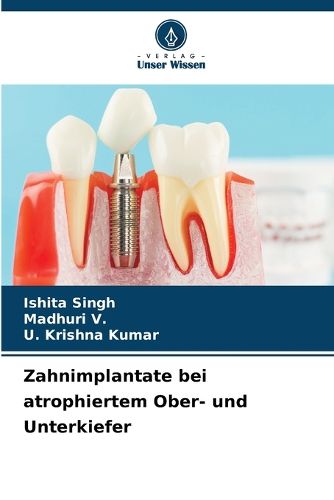 Cover image for Zahnimplantate bei atrophiertem Ober- und Unterkiefer