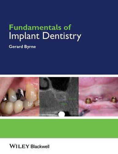 Cover image for Fundamentals of Implant Dentistry