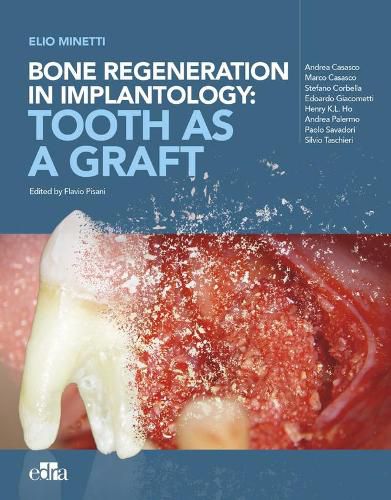 Cover image for Bone regeneration in implantology - tooth as a graft