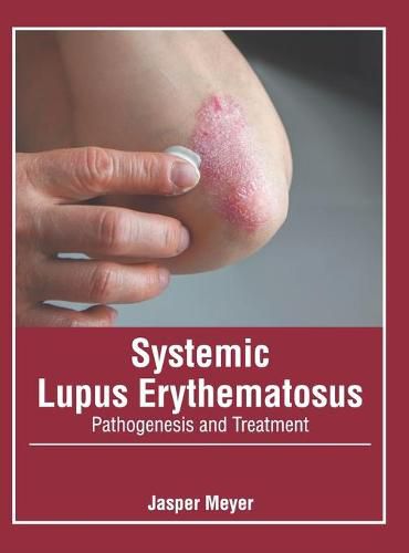 Cover image for Systemic Lupus Erythematosus: Pathogenesis and Treatment