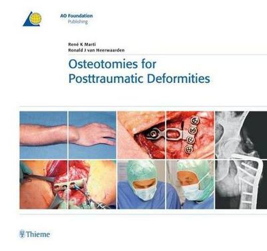 Cover image for Osteotomies for Posttraumatic Deformities