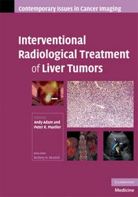 Cover image for Interventional Radiological Treatment of Liver Tumors