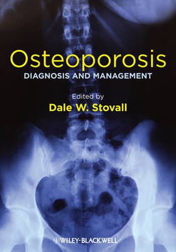 Cover image for Osteoporosis: Diagnosis and Management