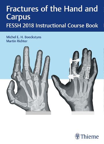 Cover image for Fractures of the Hand and Carpus: FESSH 2018 Instructional Course Book