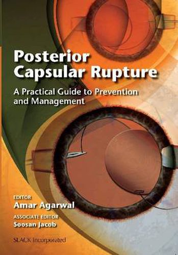 Cover image for Posterior Capsular Rupture: A Practical Guide to Prevention and Management