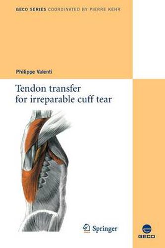 Cover image for Tendon transfer for irreparable cuff tear