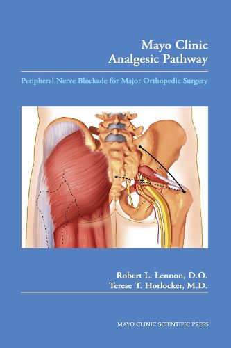 Cover image for Mayo Clinic Analgesic Pathway: Peripheral Nerve Blockade for Major Orthopedic Surgery