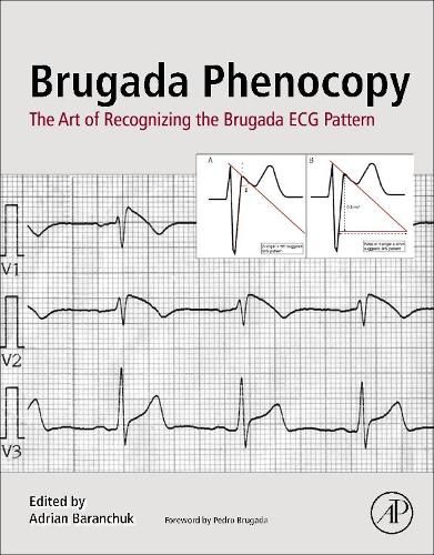 Cover image for Brugada Phenocopy: The Art of Recognizing the Brugada ECG Pattern