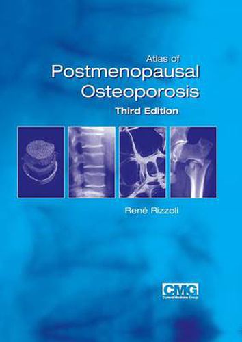 Cover image for Atlas of Postmenopausal Osteoporosis: Third Edition