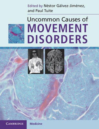 Cover image for Uncommon Causes of Movement Disorders