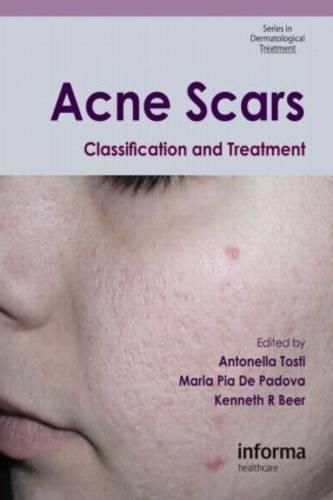 Cover image for Acne Scars: Classification and Treatment