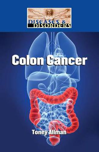 Cover image for Colon Cancer