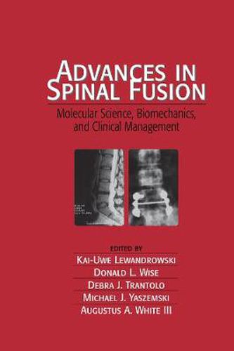 Cover image for Advances in Spinal Fusion: Molecular Science, Biomechanics, and Clinical Management