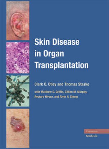 Cover image for Skin Disease in Organ Transplantation