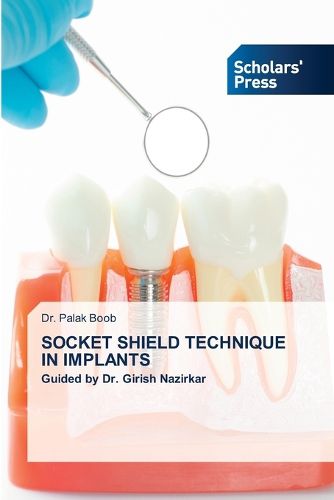 Cover image for Socket Shield Technique in Implants