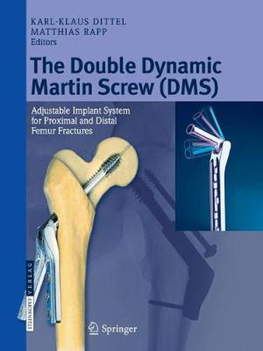 Cover image for The Double Dynamic Martin Screw (DMS): Adjustable Implant System for Proximal and Distal Femur Fractures