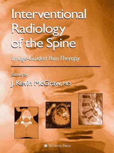 Cover image for Interventional Radiology of the Spine: Image-Guided Pain Therapy
