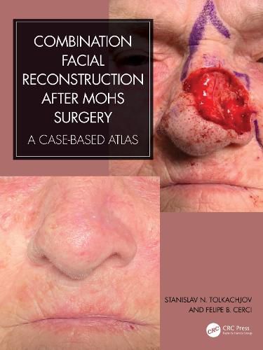 Cover image for Combination Facial Reconstruction after Mohs Surgery