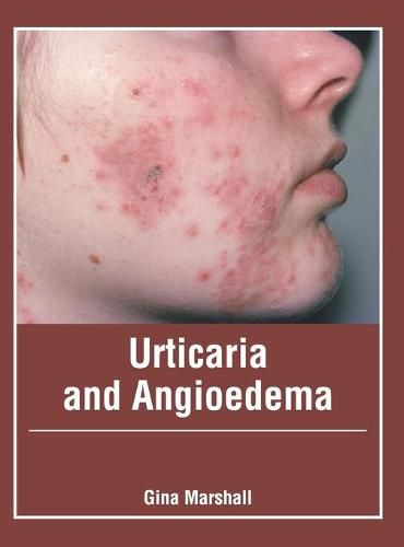 Cover image for Urticaria and Angioedema