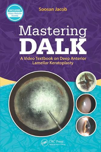 Cover image for Mastering DALK: A Video Textbook on Deep Anterior Lamellar Keratoplasty