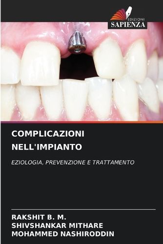 Cover image for Complicazioni Nell'impianto