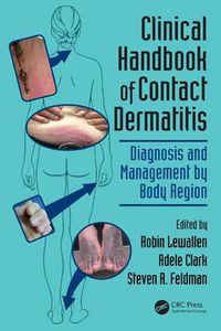Cover image for Clinical Handbook of Contact Dermatitis: Diagnosis and Management by Body Region