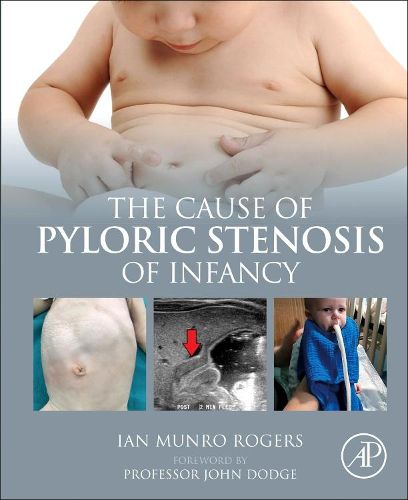 Cover image for The Cause of Pyloric Stenosis of Infancy