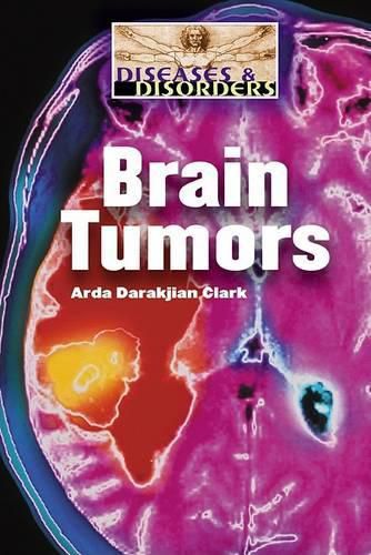 Cover image for Brain Tumors