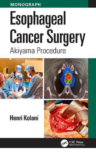 Cover image for Esophageal Cancer Surgery