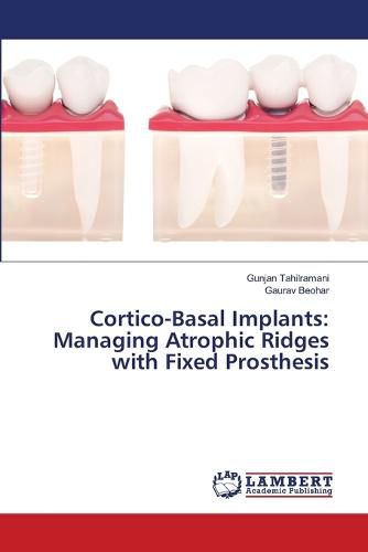 Cover image for Cortico-Basal Implants: Managing Atrophic Ridges with Fixed Prosthesis