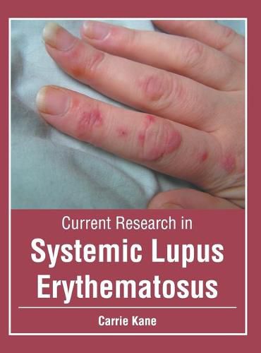 Cover image for Current Research in Systemic Lupus Erythematosus