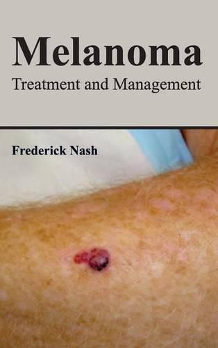 Cover image for Melanoma: Treatment and Management