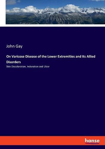 On Varicose Disease of the Lower Extremities and Its Allied Disorders: Skin Discoloration, Induration and Ulcer