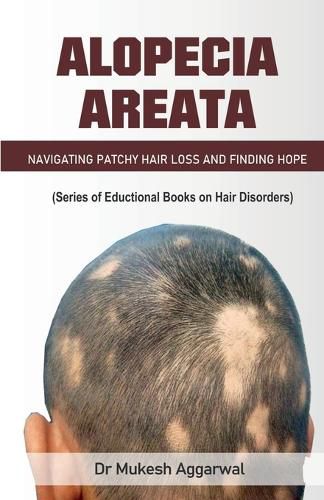 Cover image for Alopecia Areata