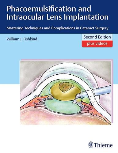 Cover image for Phacoemulsification and Intraocular Lens Implantation: Mastering Techniques and Complications in Cataract Surgery