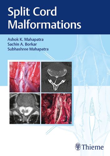 Cover image for Split Cord Malformations