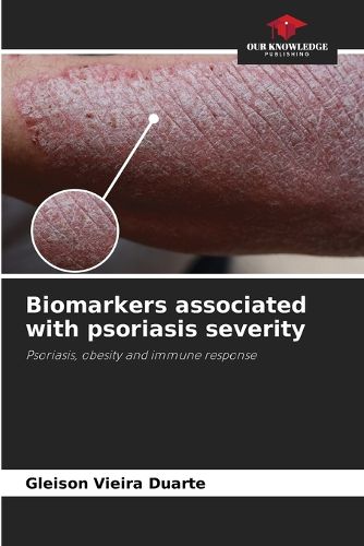 Cover image for Biomarkers associated with psoriasis severity