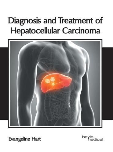 Cover image for Diagnosis and Treatment of Hepatocellular Carcinoma